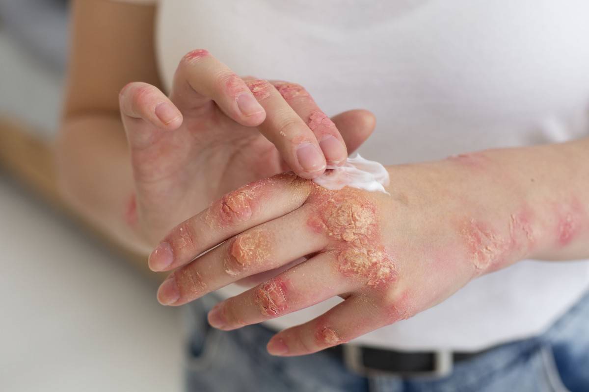Burn Treatment & Care